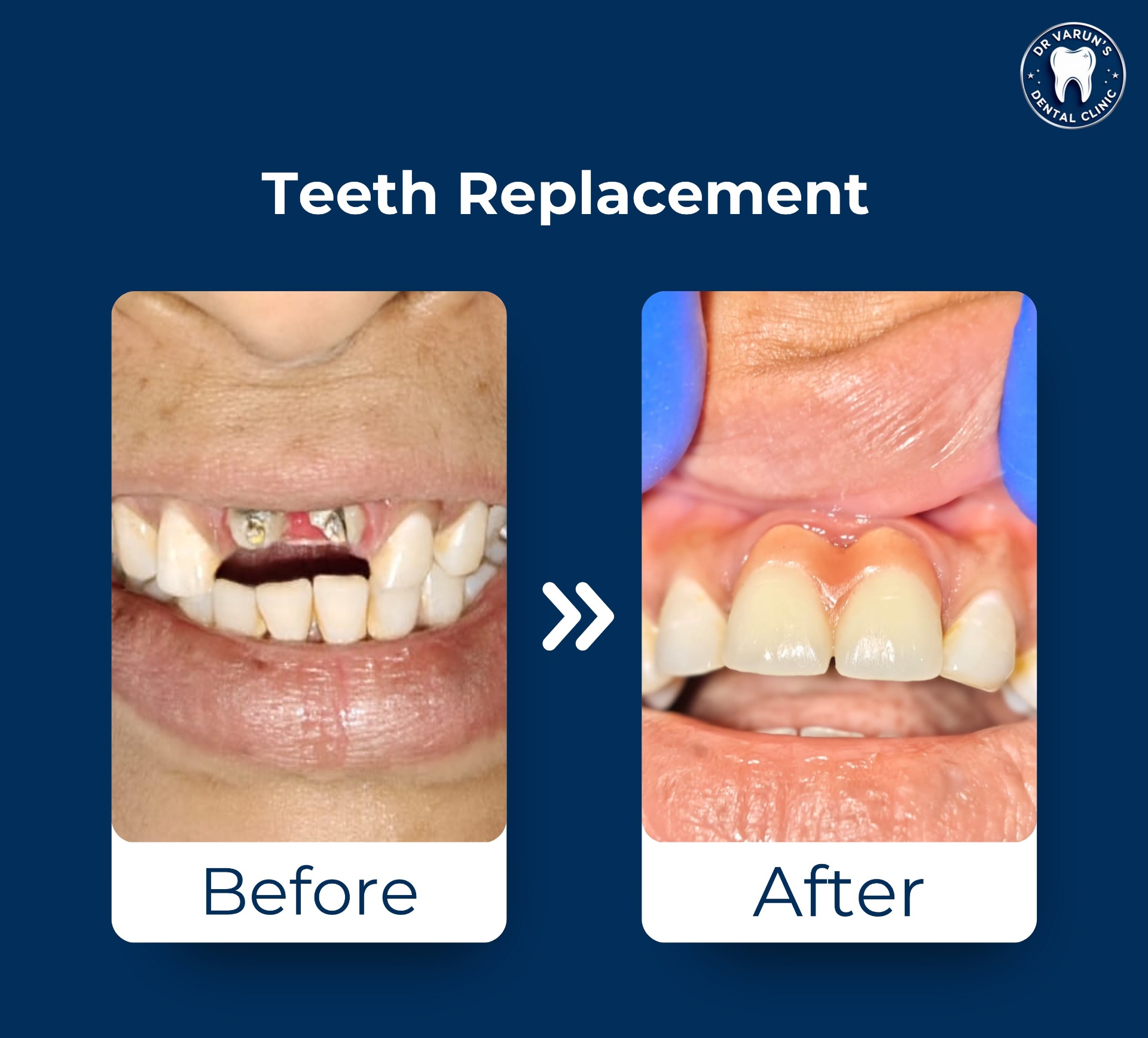 Teeth Replacement — before and after at Dr. Varun's Dental Clinic, Ahmedabad