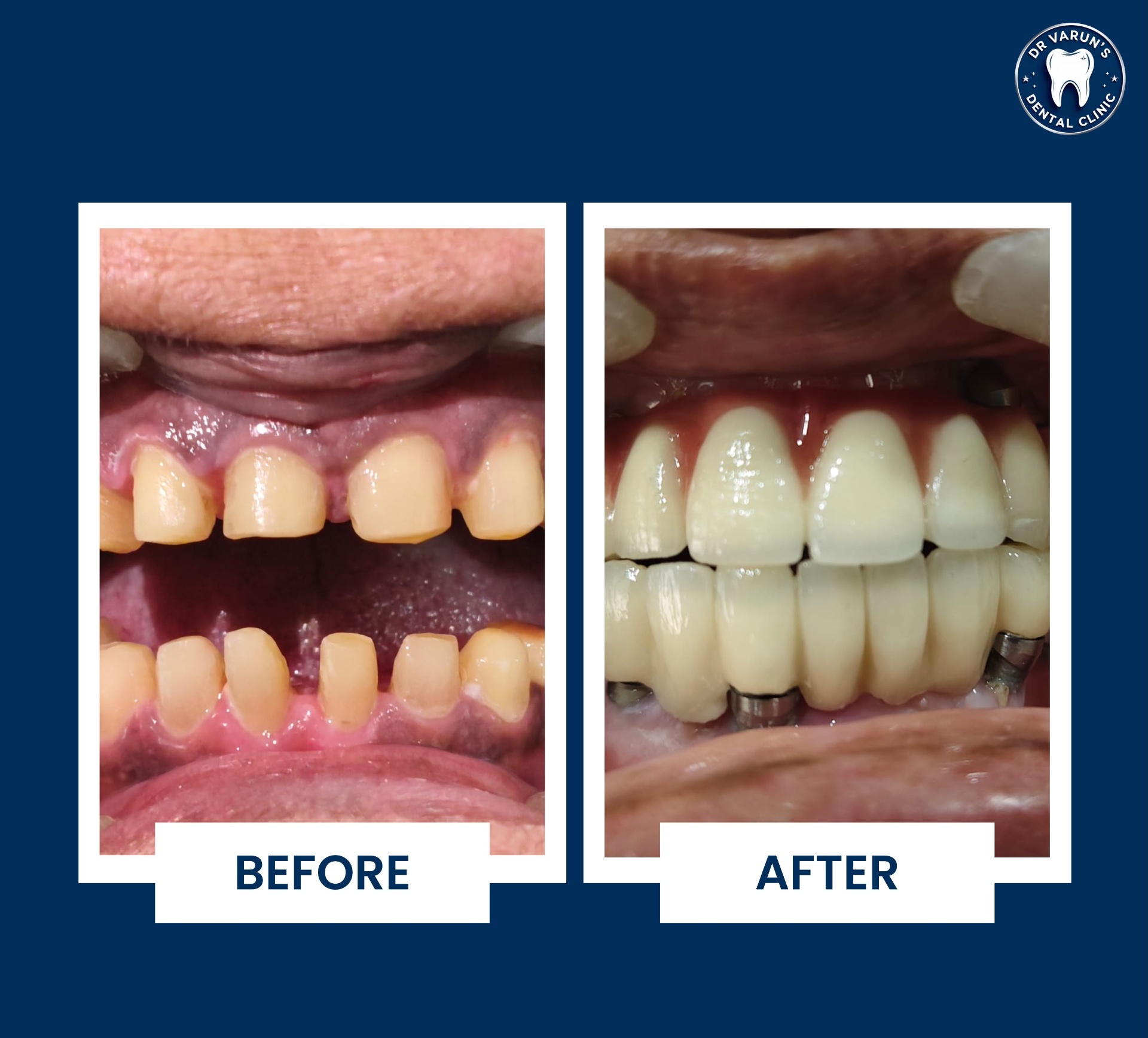 Full-Arch Implant Rehabilitation — before and after at Dr. Varun's Dental Clinic, Ahmedabad