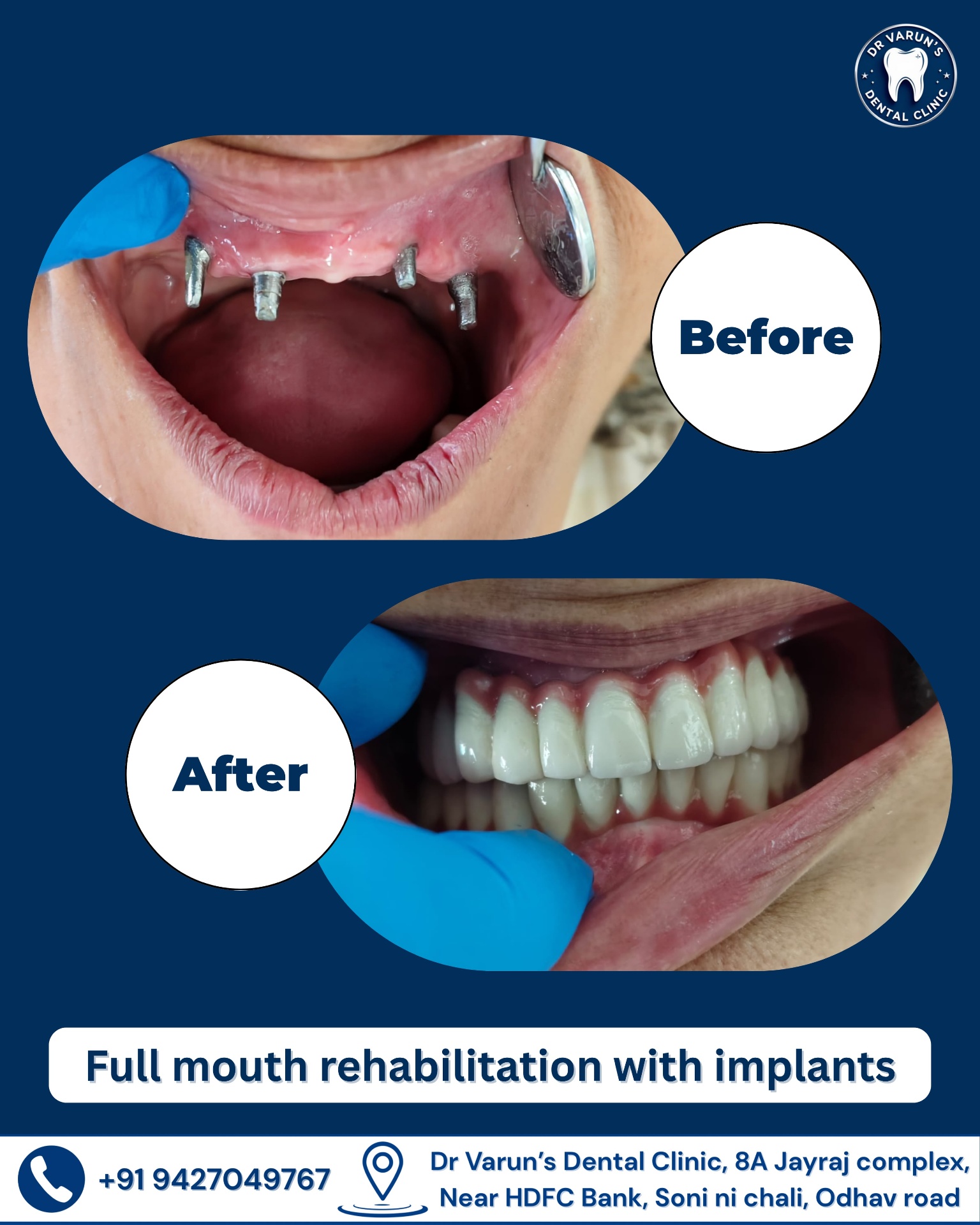 Full-Mouth Rehabilitation with Implants — before and after at Dr. Varun's Dental Clinic, Ahmedabad