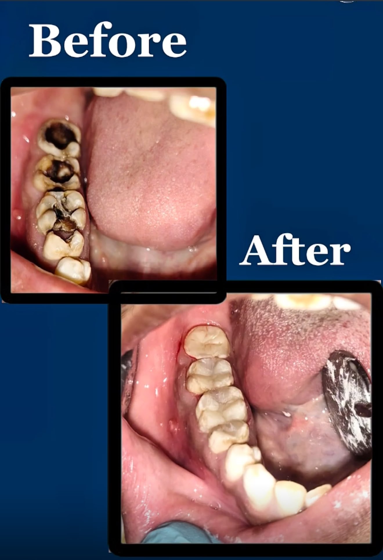 Deep Cavity Restoration — before and after at Dr. Varun's Dental Clinic, Ahmedabad